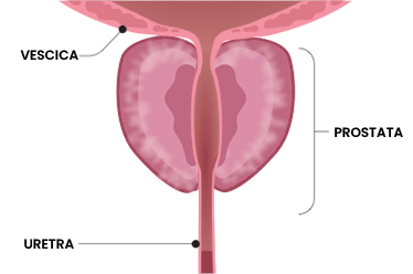 terzo step trattamento rezum