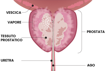 secondo step trattamento rezum