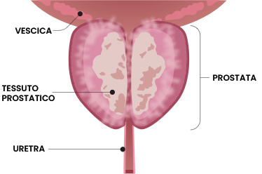 primo step trattamento rezum
